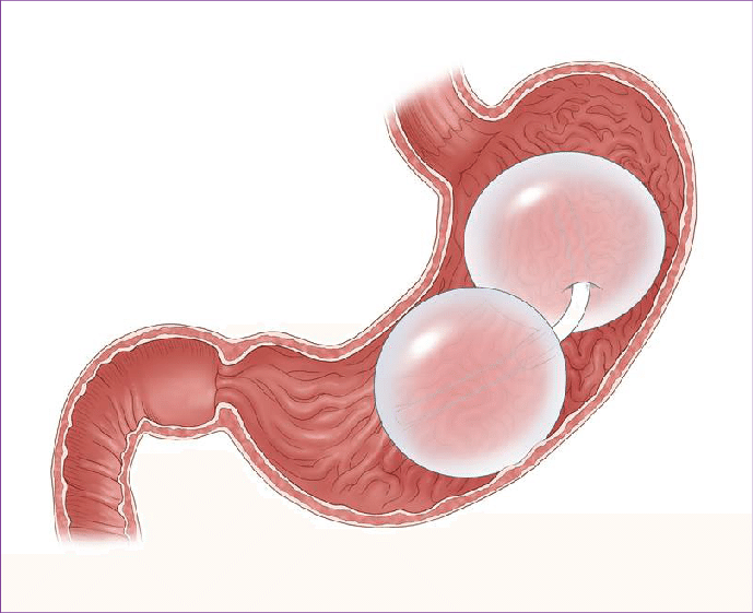 Gastric Balloon